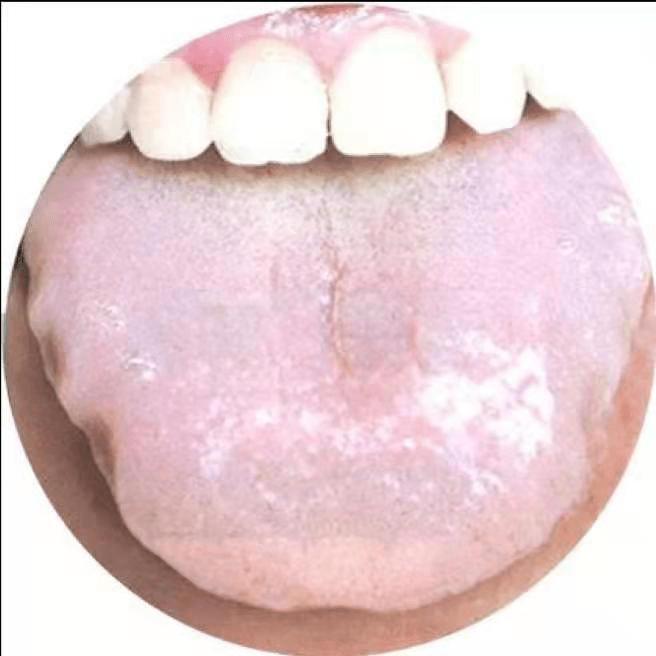 从宝宝的舌头来看: 一,脾阳虚,舌头比较胖大且能明显看到齿痕厚,这是