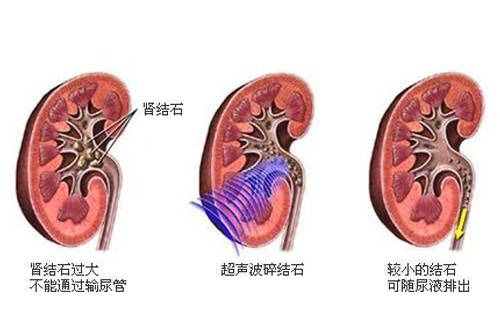 肾结石没掉下来怎么办