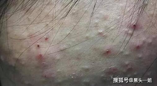怎么才能让脸部毛孔不堵塞 9c651ec4ed494b65a1b19cfd0d7465c2.jpeg