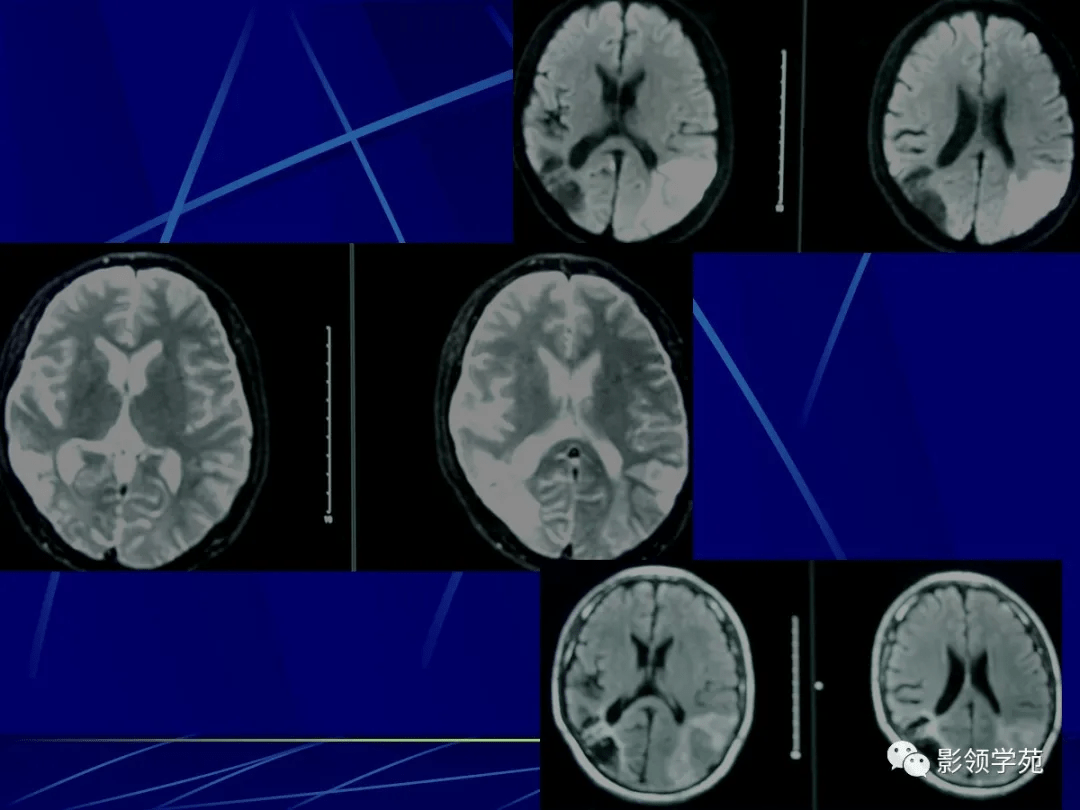 头颅MRI中不同序列DWI和ADC的区别_诊断