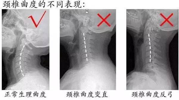 脖子一扭咔咔响,这样对颈椎好吗?_头部