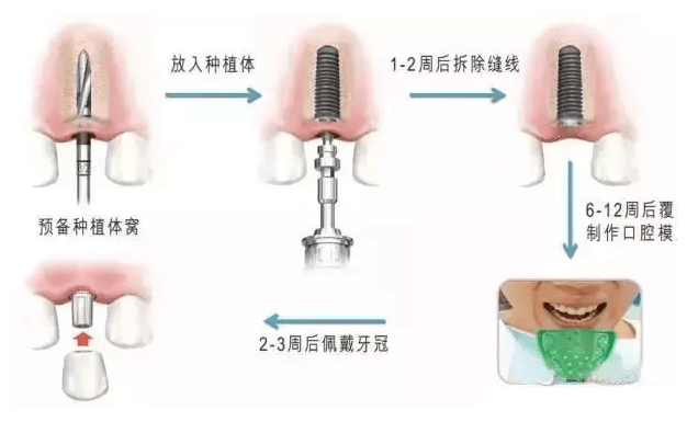 牙齿缺失影响全身健康千万不能忽视特别是老年人