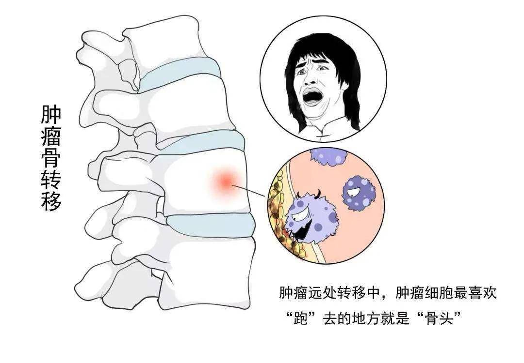 如何判断肿瘤发生骨转移疼痛并不是评价诊断金标准