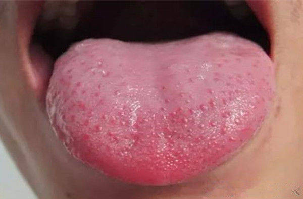 如果舌头的中间发红,这是胃火积盛的表现.