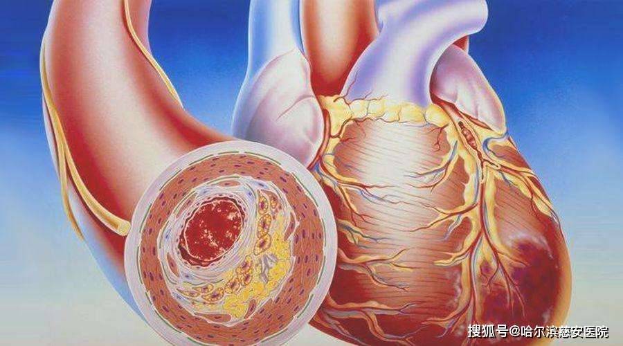 原因是心房颤动,心房和心室不协调收缩导致血液停止,在左心房形成血栓