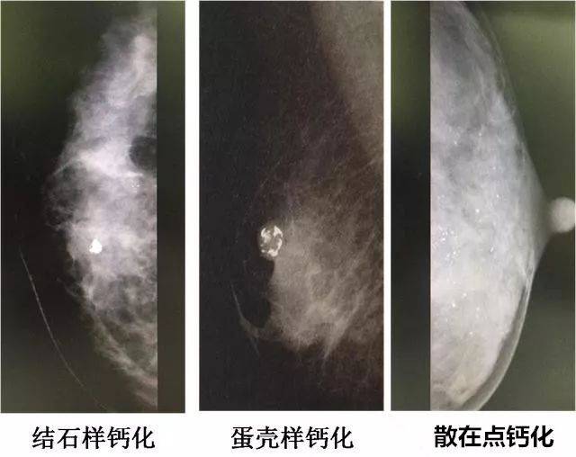 乳腺钙化灶离乳腺癌有多远?_手机搜狐网