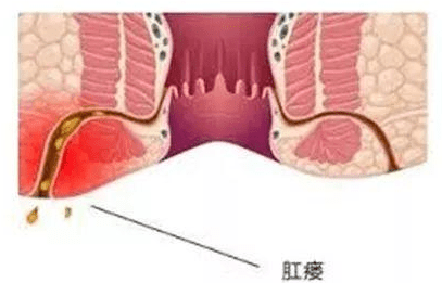 冬季肛肠病高发,是"攒着"还是"治疗"?_肛门