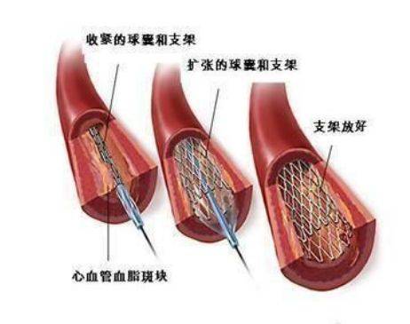 什么时候需要做心脏支架 7354cd0c96b942b086c37c6b5e6ee19d.jpeg