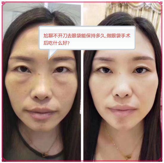 什么是水肿眼袋 1f5546adb14f4c5385b3ec363b29b86f.jpeg