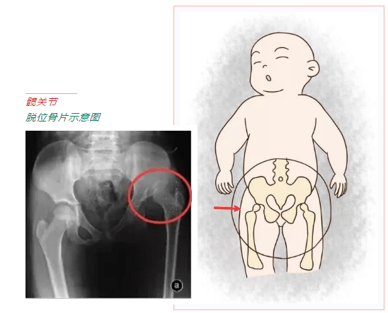 四维动态稳定复位非手术综合治疗儿童髋关节脱位安全更有效