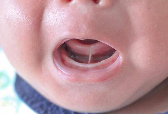 宝宝的舌系带,到底该不该剪?