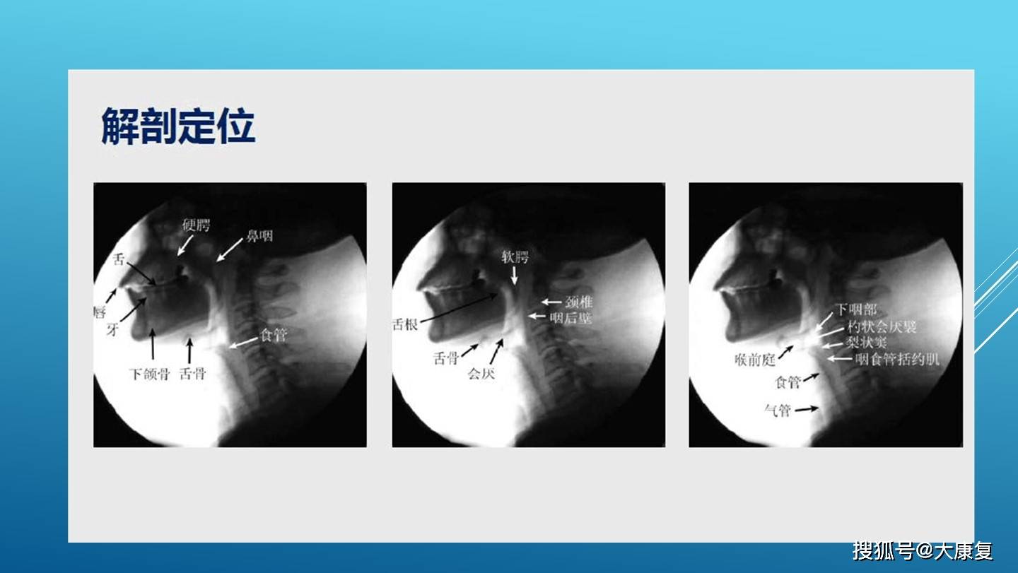 吞咽造影检查(vfss)