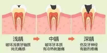 牙齿烂根怎么办