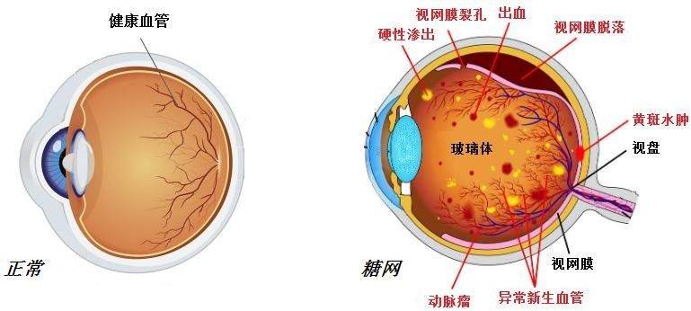 糖尿病视网膜病变是怎么回事?