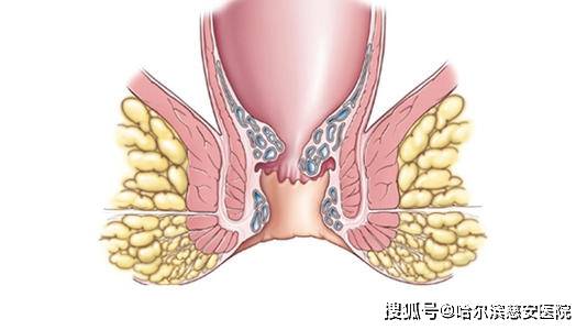 肛瘘是肛门直肠瘘的简称,是发生在肛门直肠周围的脓肿溃破或切口引流