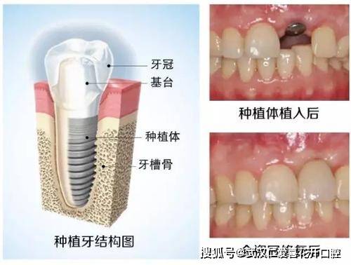 种植牙和烤瓷牙区别在哪?为何大多数更倾向于种植