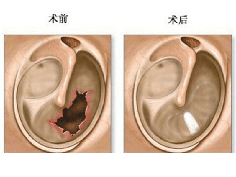 2,爆炸性鼓膜穿孔,因鳞状上皮内翻进入鼓室而形成鳞状上皮囊肿,容易