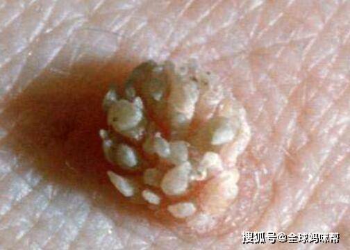 包括hpv5,8,14,,17,20,36,38与疣状表皮发育不良有关,其他还与可能