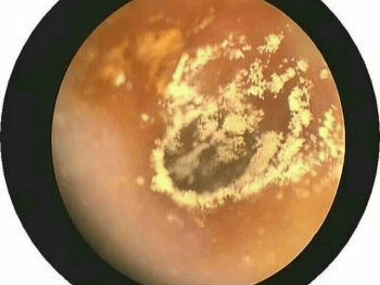 贵阳铭仁耳鼻喉医院可怕的真菌性外耳道炎女子耳朵奇痒检查竟有细菌