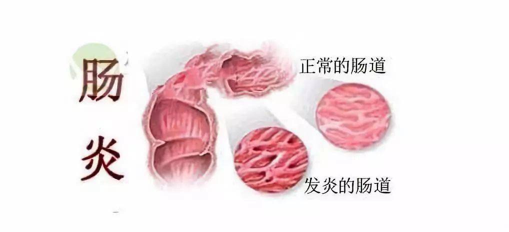 得了肠炎苦不堪言，该怎样有效治愈肠炎？