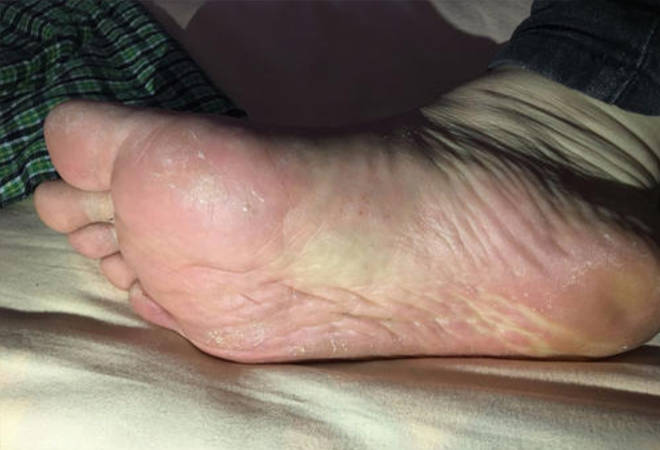 4,鳞屑角化型脚气 这类情况如果比较轻微者,建议涂抹立清宁皮肤修护