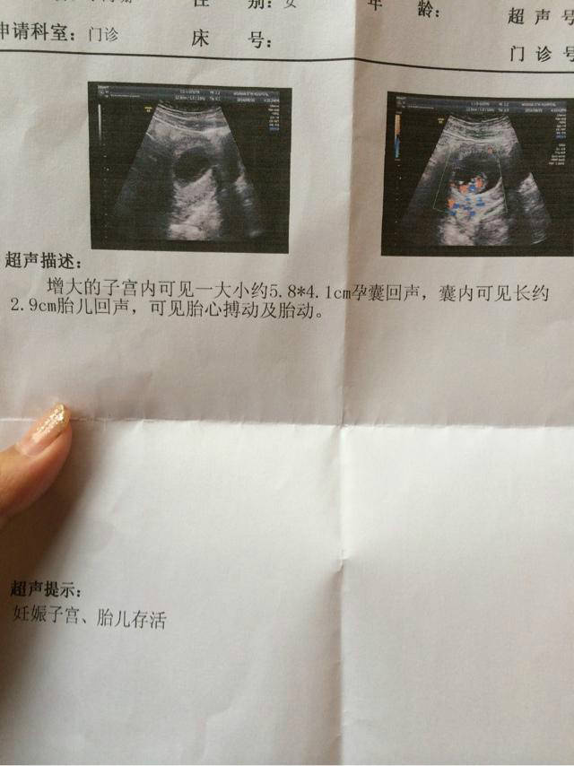 孕10周胎儿,好萌好可爱,小胳膊小腿可以看到小人形啦!