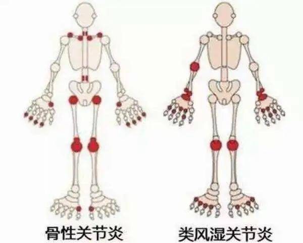 周围少有炎症表现,其次为负重关节,如膝关节,肩关节,髋关节,颈椎,腰椎