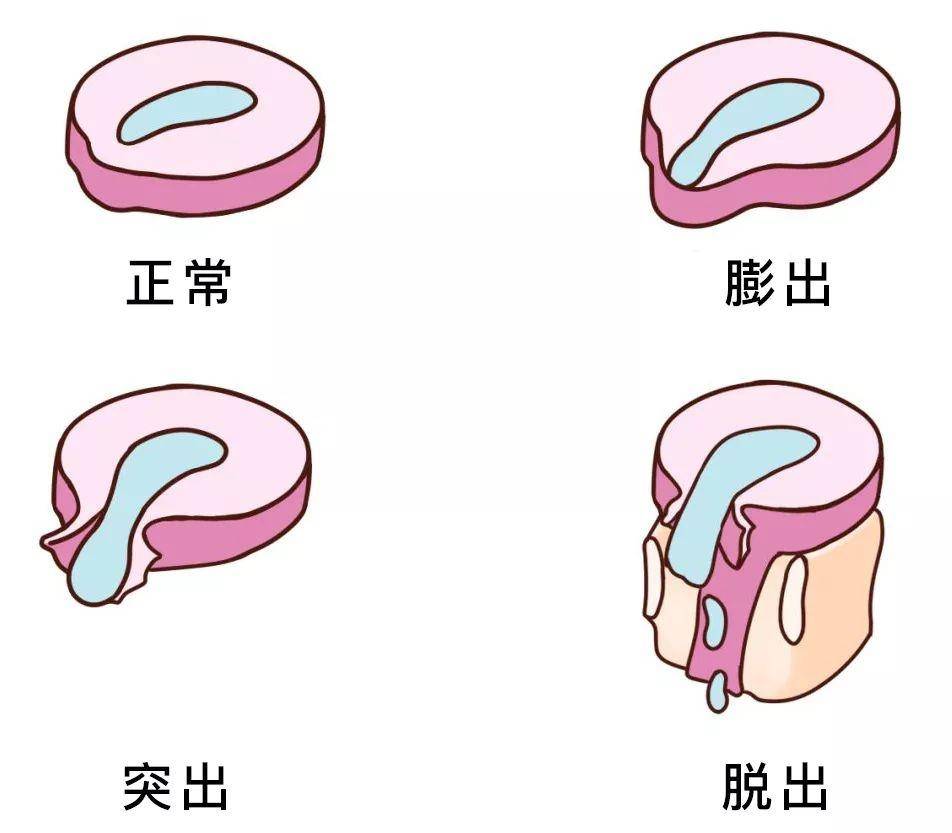 原创腰间盘突出压迫神经了,腰腿疼有什么好的治疗方法?医生为您介绍