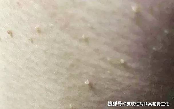 高艳青长在脖子上的小肉揪与尖锐湿疣有关系吗