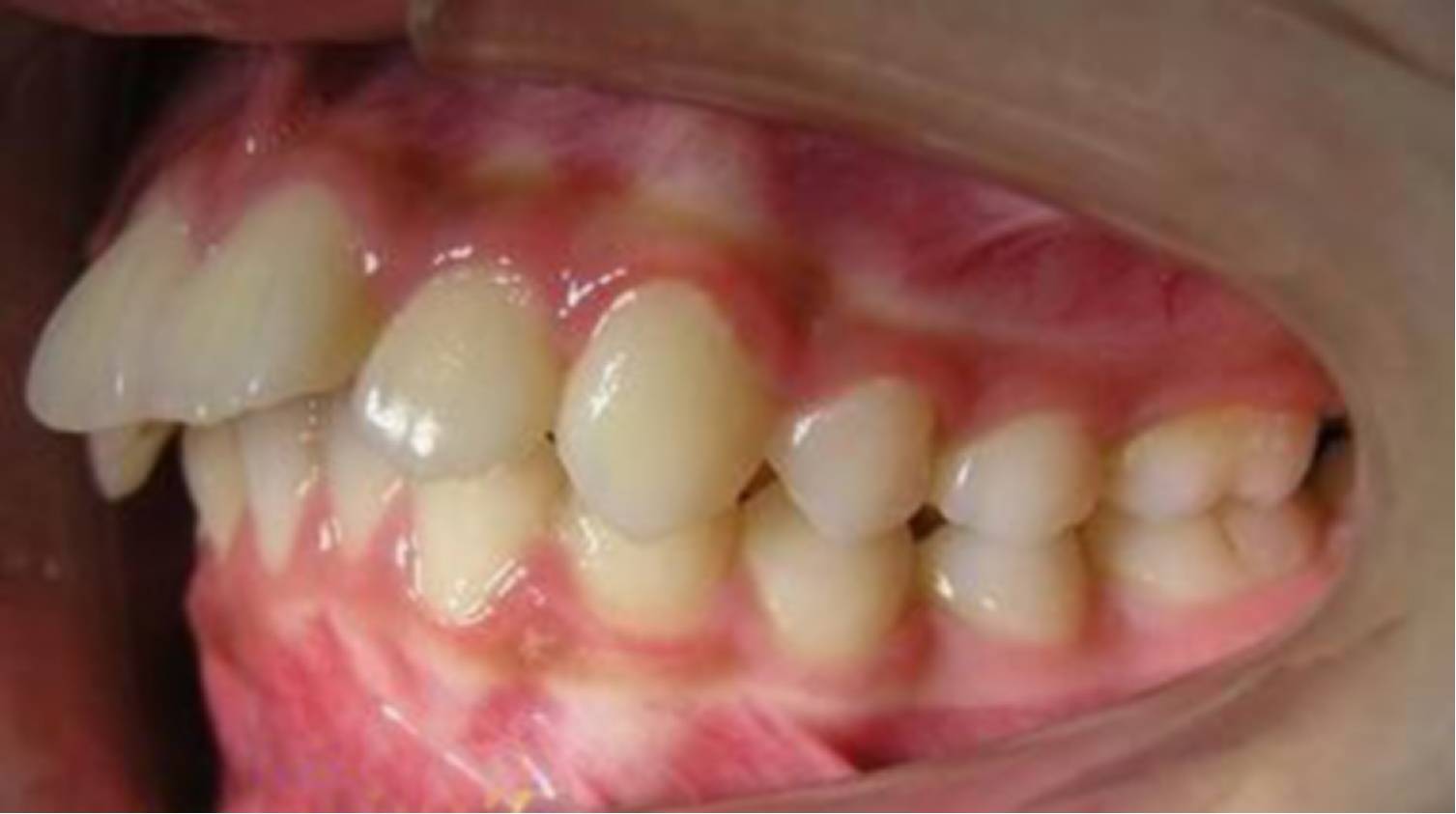 如何区分自己的龅牙属于骨性还是牙性?