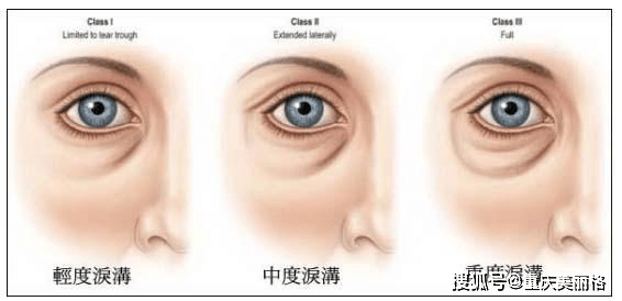 这一类黑眼圈指的就是由眼袋和眼周细纹或凹陷所导致的黑眼圈,常见