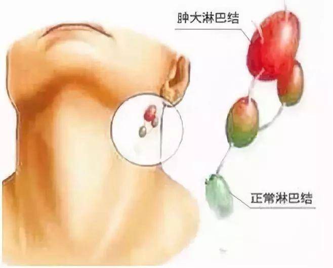 脖子若出现这3"症状",或是癌细胞作乱