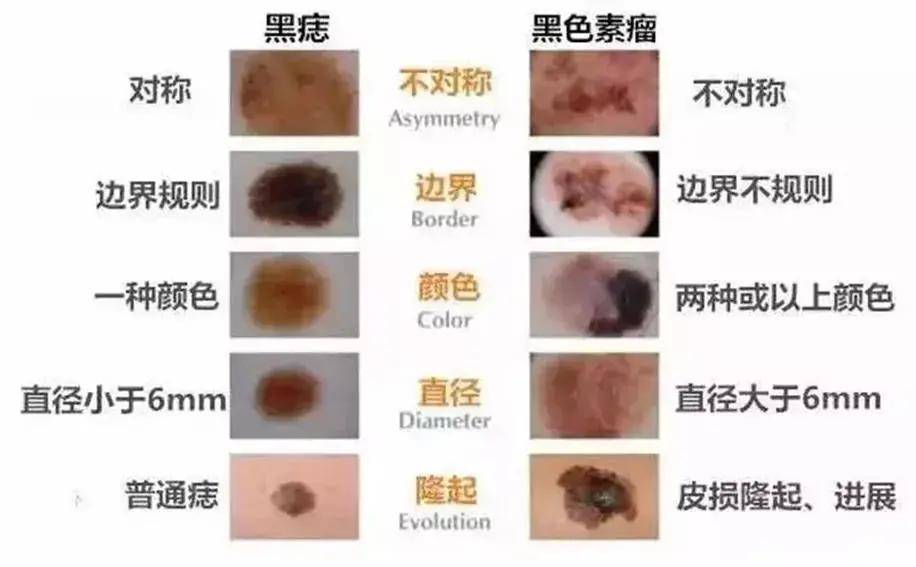 ④痣不断变大或变得突出; ⑤痣的周围出现新的病变; ⑥先天性色素痣