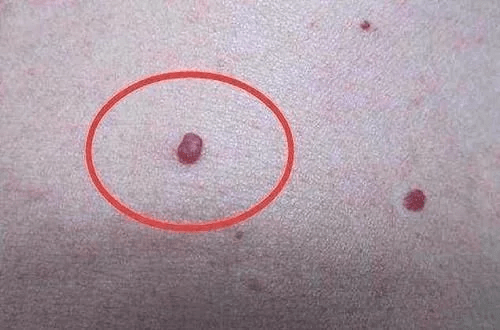 身上出现这2种"小红点",十有八九是肝病,专家告诫:别大意