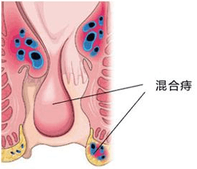 混合痔以发生于肛门同一方位齿线上下,静脉曲张形成团块,内外相连,无