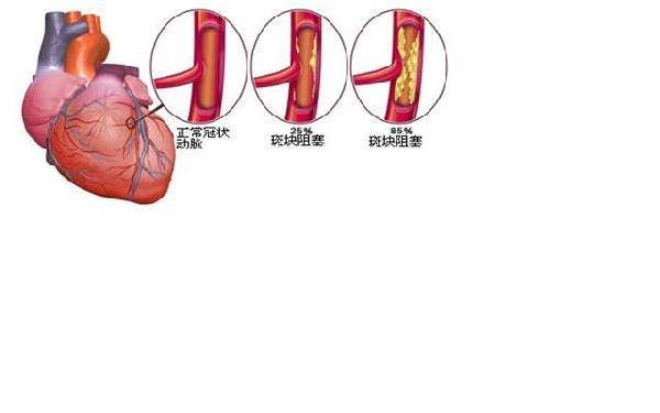心脏隐隐作痛是怎么回事?专家:可能是冠心病引起