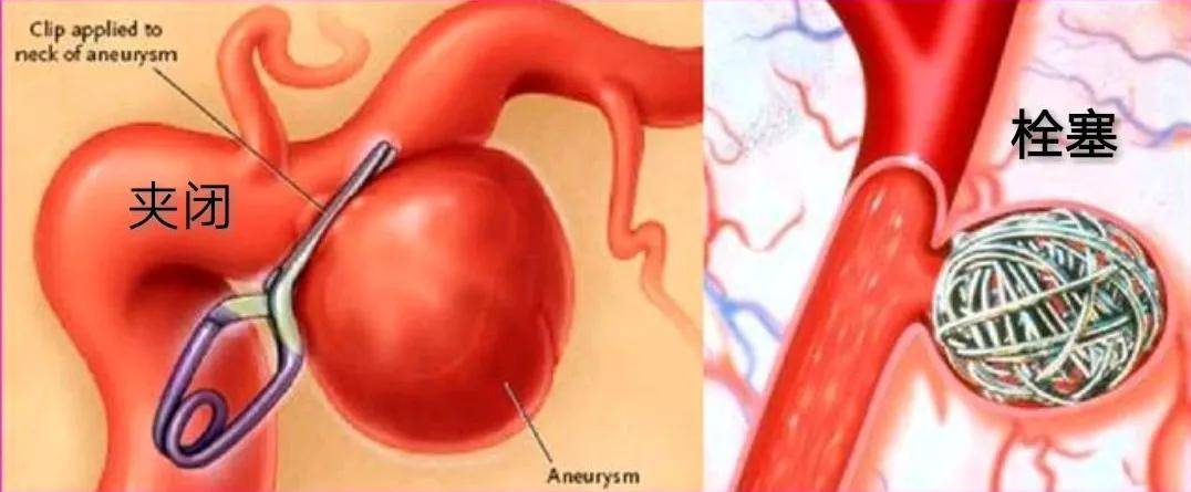 脑动脉瘤的介入治疗
