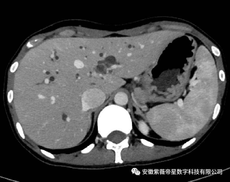 冠状面沿胆管壁广泛浸润,管壁增厚,管腔狭窄,管周结缔组织明显炎症