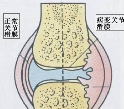 由于各种炎症因子的介入,关节腔内滑液的理化性质发生改变,关节滑膜的