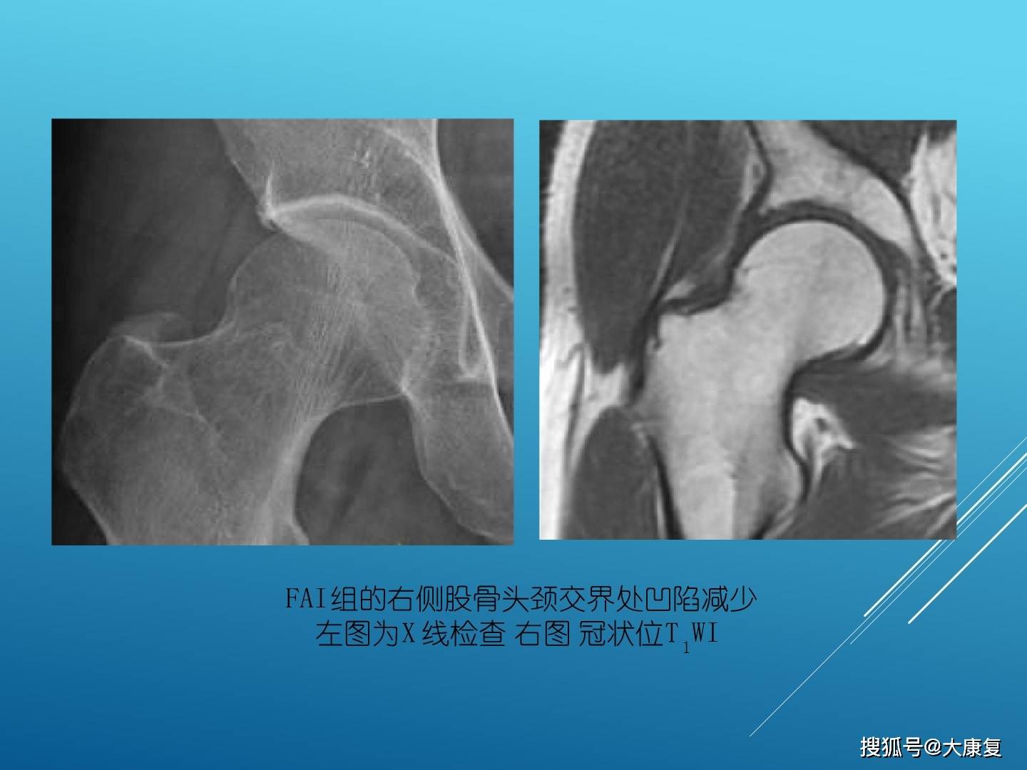 股髋关节撞击综合症