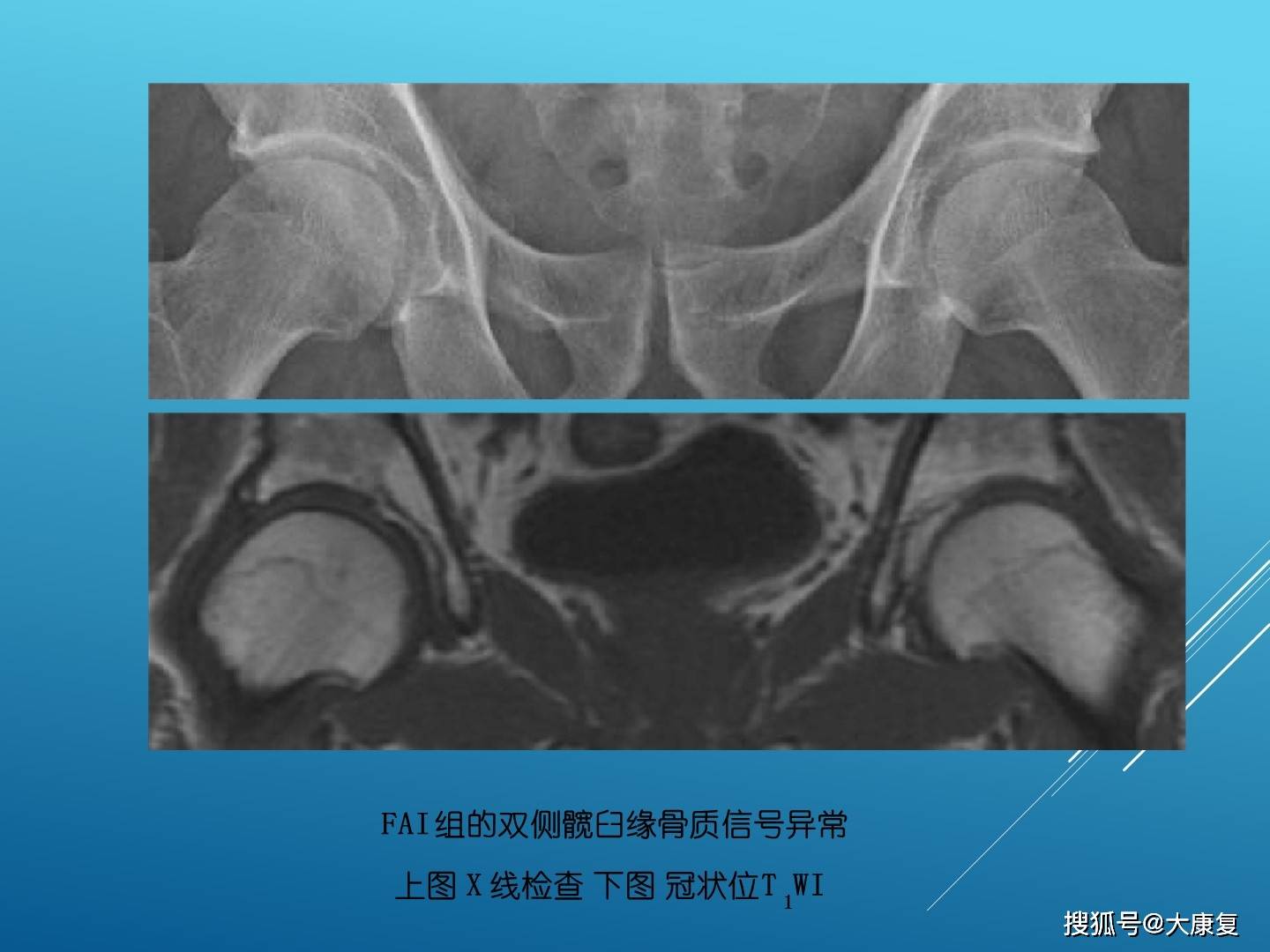 股髋关节撞击综合症