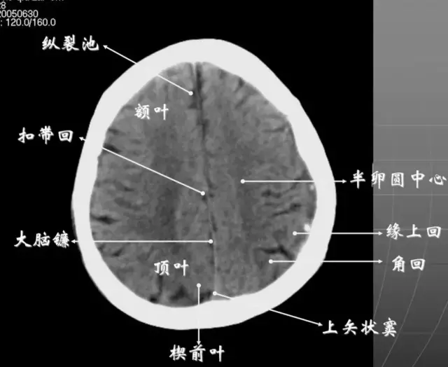 简明又详细的头部ct读片详解,收藏!