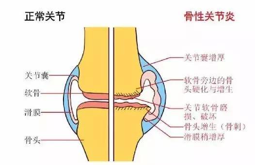 老年人为什么会得膝骨关节炎?