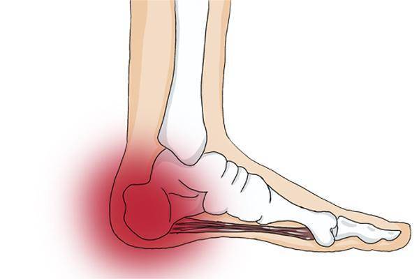 4,脚后跟疼痛关节或骨刺肿瘤等问题的前兆是脚跟出现疼痛,一旦发现这