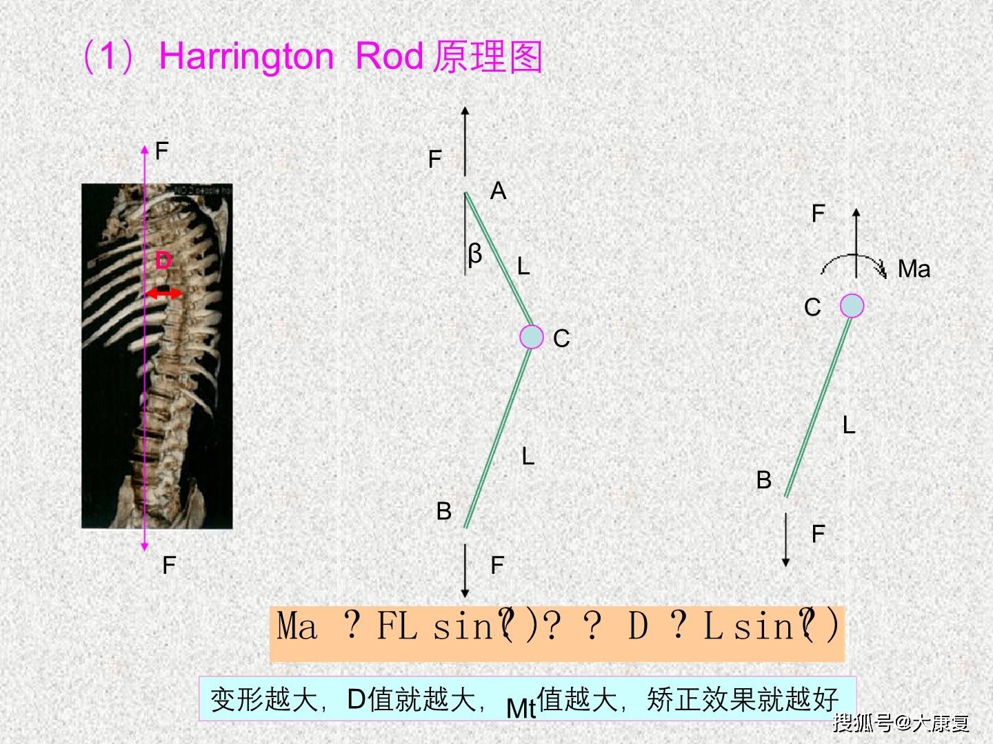 脊柱侧弯的实用生物力学