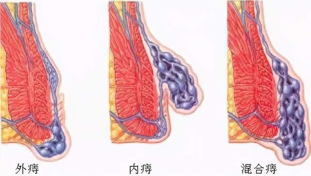 如何判断你患的是痔疮or直肠息肉?