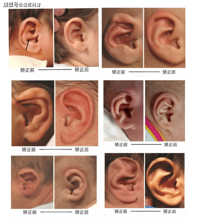 整形医生安波教授宝宝常见畸形耳朵包括哪些1,外形不好看.