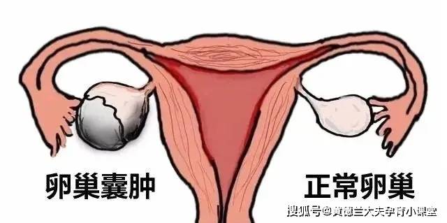 黄德兰大夫科普:体检发现卵巢囊肿,怎么办?需要手术治疗吗?