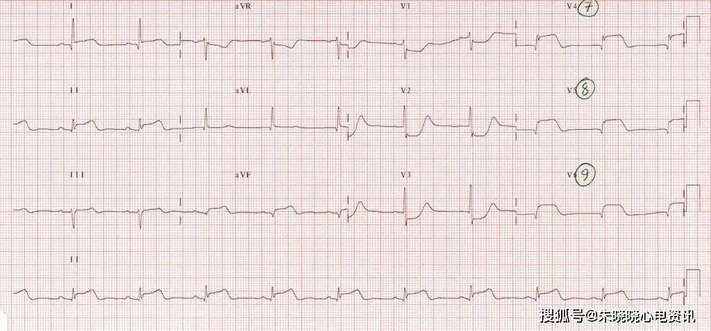 心肌缺血的心电图表现