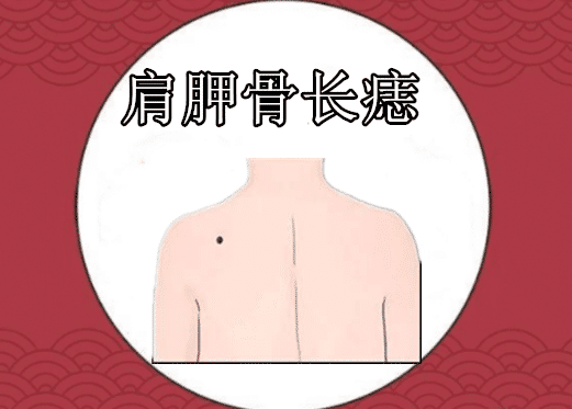 肩胛骨长痣